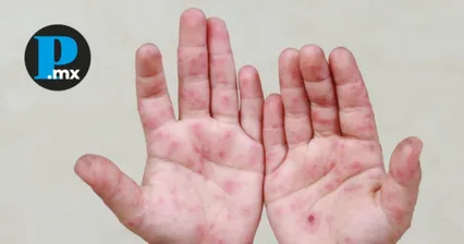 La SEP reportó 419 contagios del virus Coxsackie en el estado de Puebla 