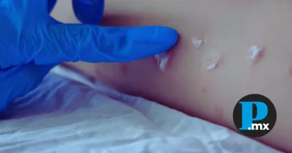 Las ampollas del coxsackie podría confundirse con viruela de mono