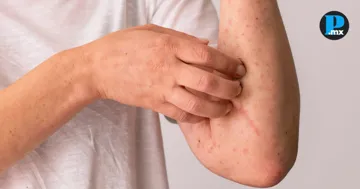 Van 33 contagios de sarampi&oacute;n en Puebla, la mayor&iacute;a en adultos