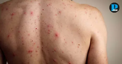 Sarampi&oacute;n avanza en M&eacute;xico; ya son 31 las muertes por esta enfermedad