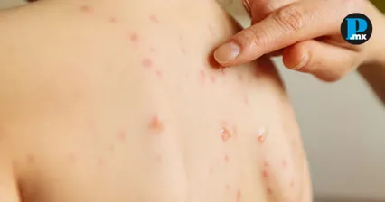 Confirman 128 casos de sarampi&oacute;n en Puebla y cinco son de otros estados