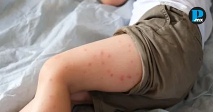 Reportan 164 contagios de sarampi&oacute;n en 15 municipios de Puebla