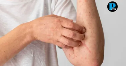 México encabeza la lista de muertes por sarampión en América Latina