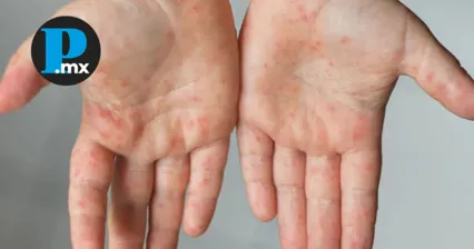 Brotes de virus Coxsackie suman 201 casos en Puebla durante este año