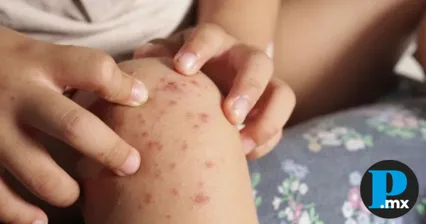 Confirmados seis casos de virus Coxsackie en escuela de Atlixco