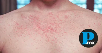 OPS advierte a M&eacute;xico sobre riesgo de perder certificaci&oacute;n libre de sarampi&oacute;n