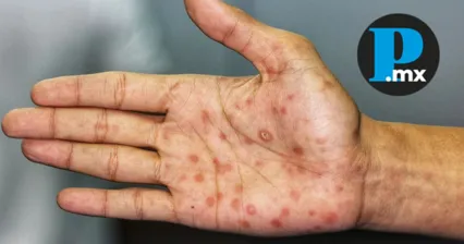 Siete estados concentran casi la mitad de los casos de sífilis en México