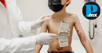 Puebla acumula m&aacute;s de 2 mil casos de quemaduras en lo que va del a&ntilde;o