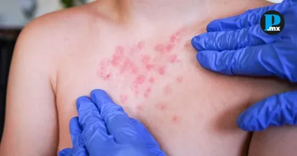 Sarampi&oacute;n cobra su primera v&iacute;ctima en M&eacute;xico y casos siguen al alza