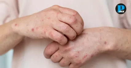 Salud reporta 38 casos de sarampi&oacute;n en Puebla y 127 sospechosos m&aacute;s