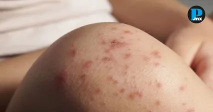 Suman 40 contagios de sarampi&oacute;n en Puebla; vigilan 152 sospechosos