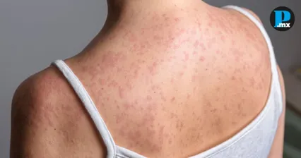 Suman 73 casos de sarampi&oacute;n en Puebla; hay 241 en estudio