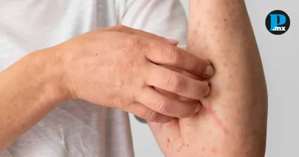 Sarampi&oacute;n no cede en Puebla: detectan 7 nuevos casos; ya suman 102 casos confirmados