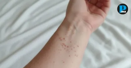 Casos de sarampi&oacute;n en Puebla suben a 141; 11 municipios afectados