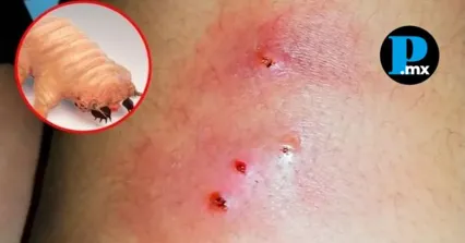 Caso de miasis humana en Puebla se suma a los reportes registrados en M&eacute;xico durante 2026.