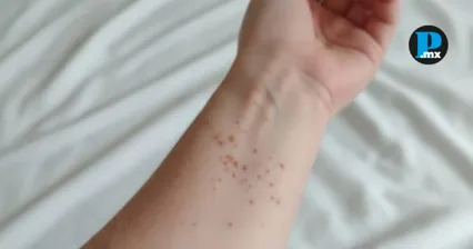 Sube a 206 el n&uacute;mero de casos de sarampi&oacute;n en Puebla