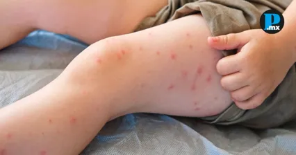 Casos de sarampi&oacute;n en Puebla suben a 237; alertan por contagios