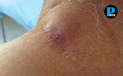 Las se&ntilde;ales de alerta incluyen gusanos visibles en heridas, mal olor e inflamaci&oacute;n severa