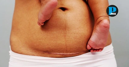 La ces&aacute;rea se ha convertido en una pr&aacute;ctica cada vez m&aacute;s frecuente en los nacimientos en M&eacute;xico.