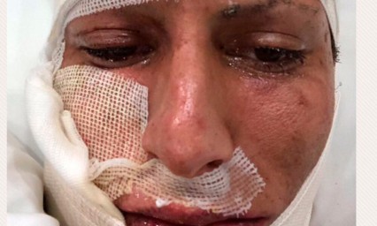 As&iacute; qued&oacute; el rostro de J&uuml;rgen Damm tras accidente con pirotecnia