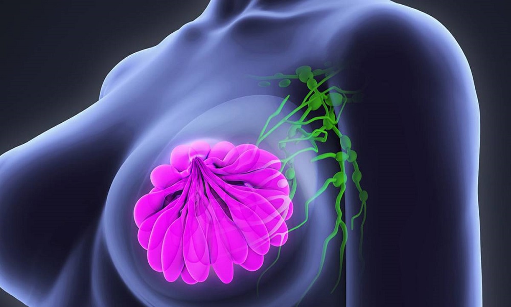 Distinguir los subtipos de cáncer de mama mejora las posibilidades de tratamiento 