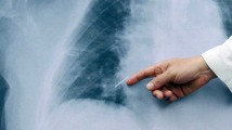 Diagnóstico tardío causa daños cerebrales a pacientes con cáncer de pulmón