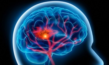 Derrames cerebrales, más graves en pacientes con Covid-19: experto