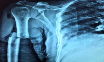 Cerro le cae encima a dos trabajadores