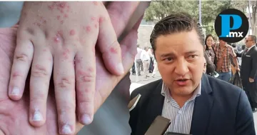 Confirma SESA siete casos de virus Coxsackie en escuelas de Tlaxcala; descarta brote alarmante