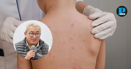 Confirman caso de sarampi&oacute;n en Tetla; autoridades de Tlaxcala se contradicen