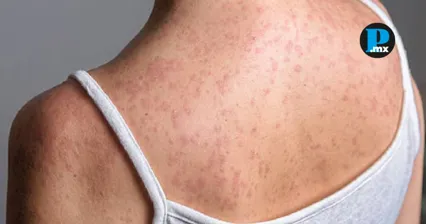 Confirman cinco casos de sarampi&oacute;n en Tlaxcala