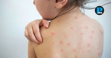 Analizan posible primer fallecimiento por sarampi&oacute;n en Tlaxcala
