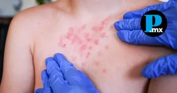 Al corte del 5 de febrero, la entidad report&oacute; 13 casos confirmados de sarampi&oacute;n; llaman a reforzar vacunaci&oacute;n. 