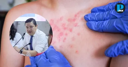 Sesa confirma 27 casos de sarampi&oacute;n y tres defunciones en Tlaxcala